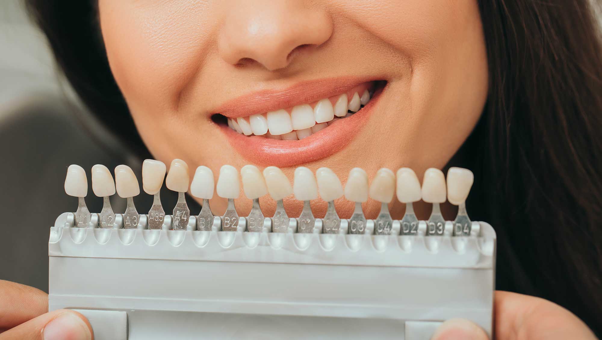 Do Porcelain Veneers Damage Your Teeth?