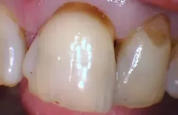 bonding-before-02 bonding-before-02