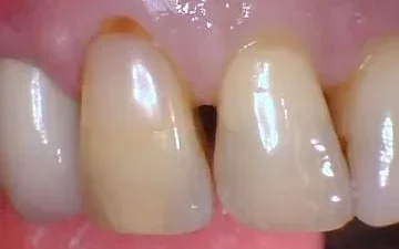 dental-bonding-before dental-bonding-before