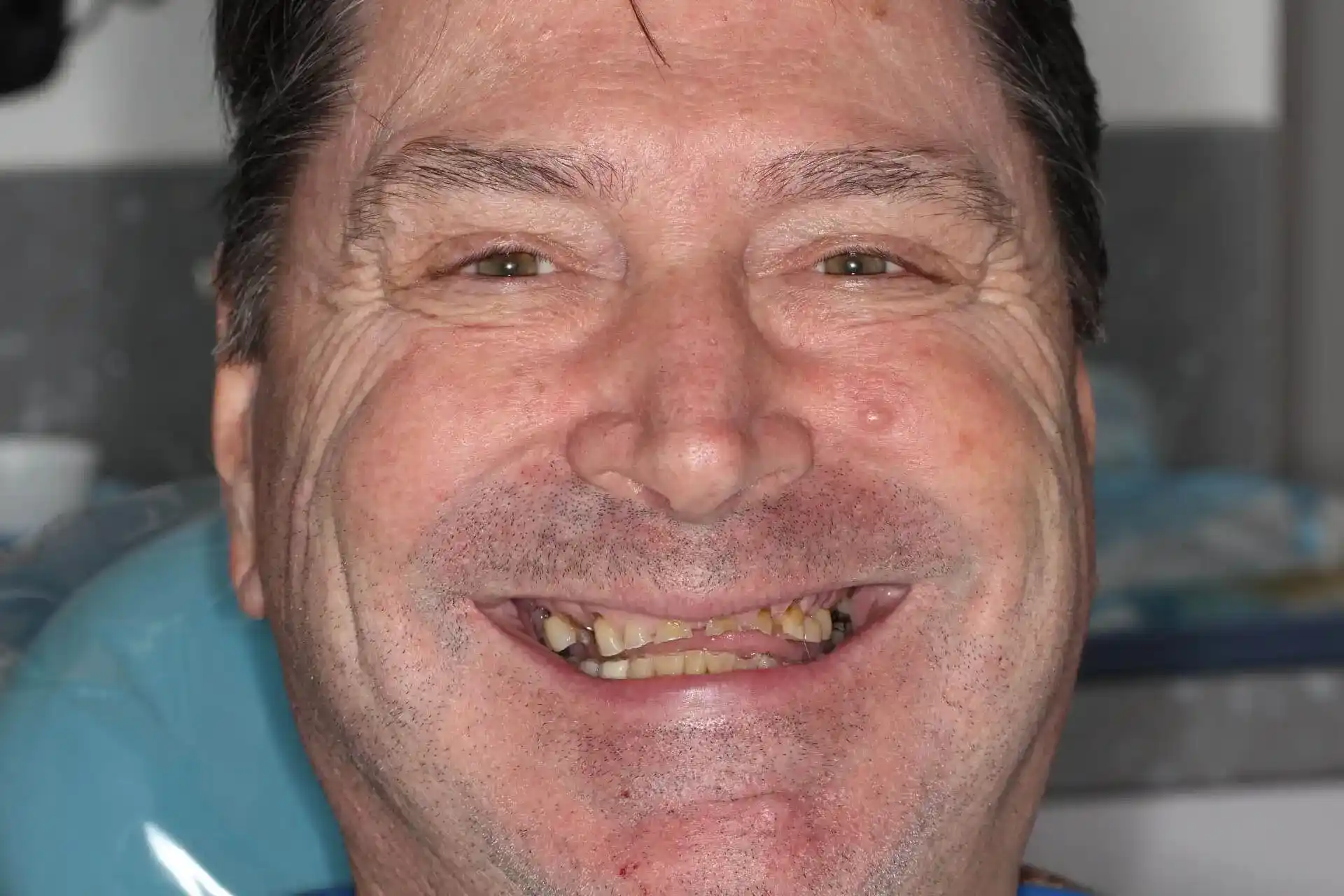 full-mouth-before-01