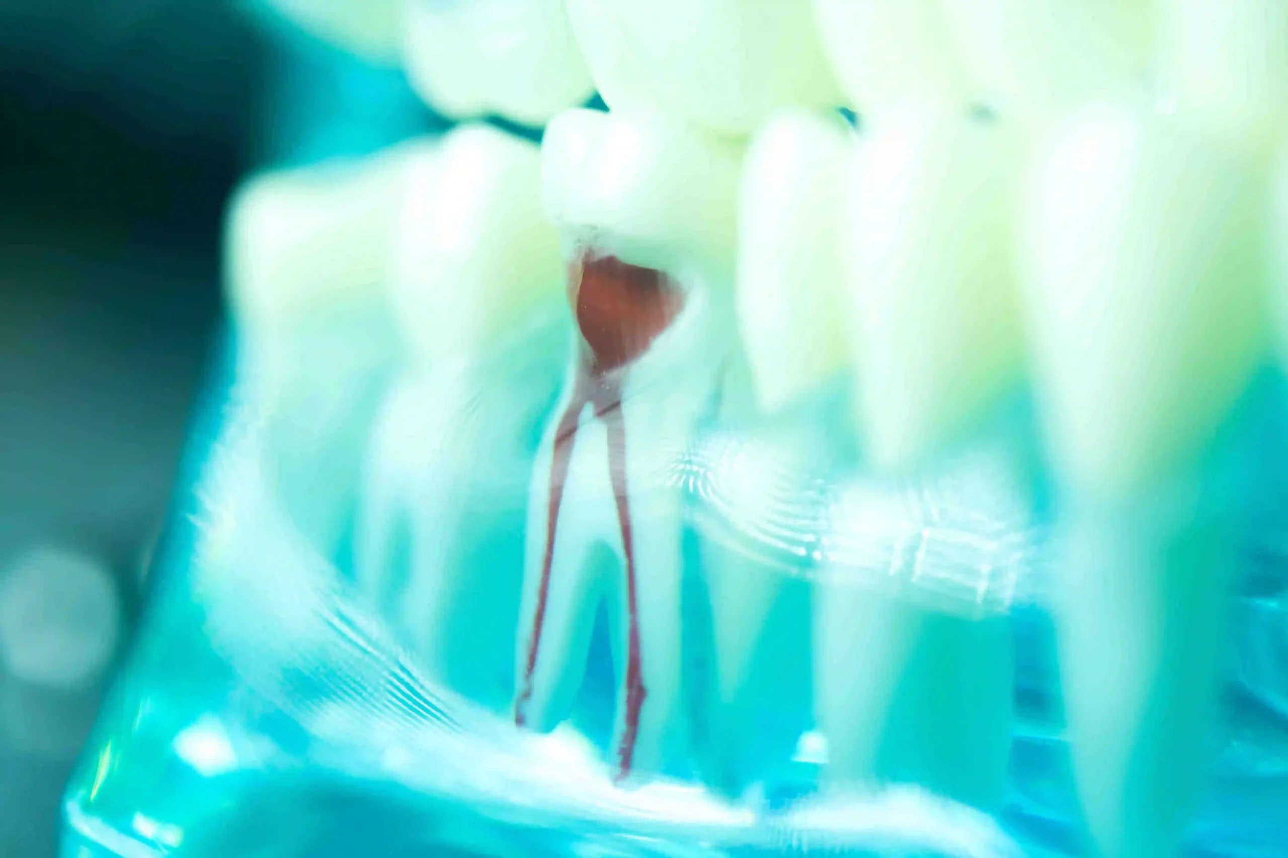 Is A Root Canal A Dental Emergency?