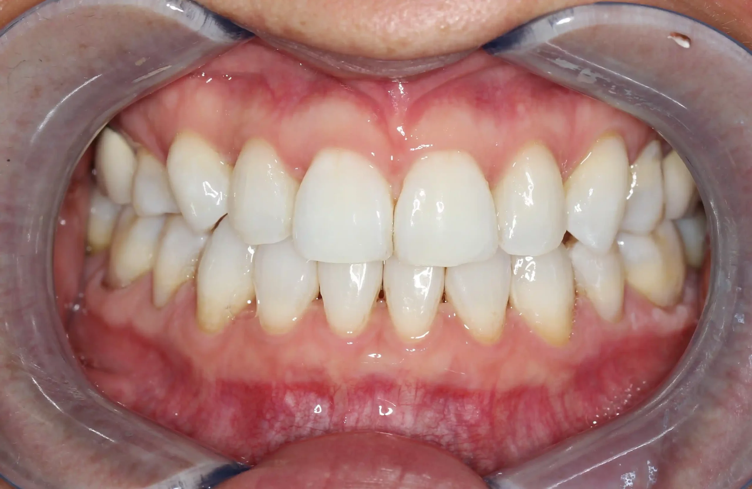 ICE_after-invisalign-2