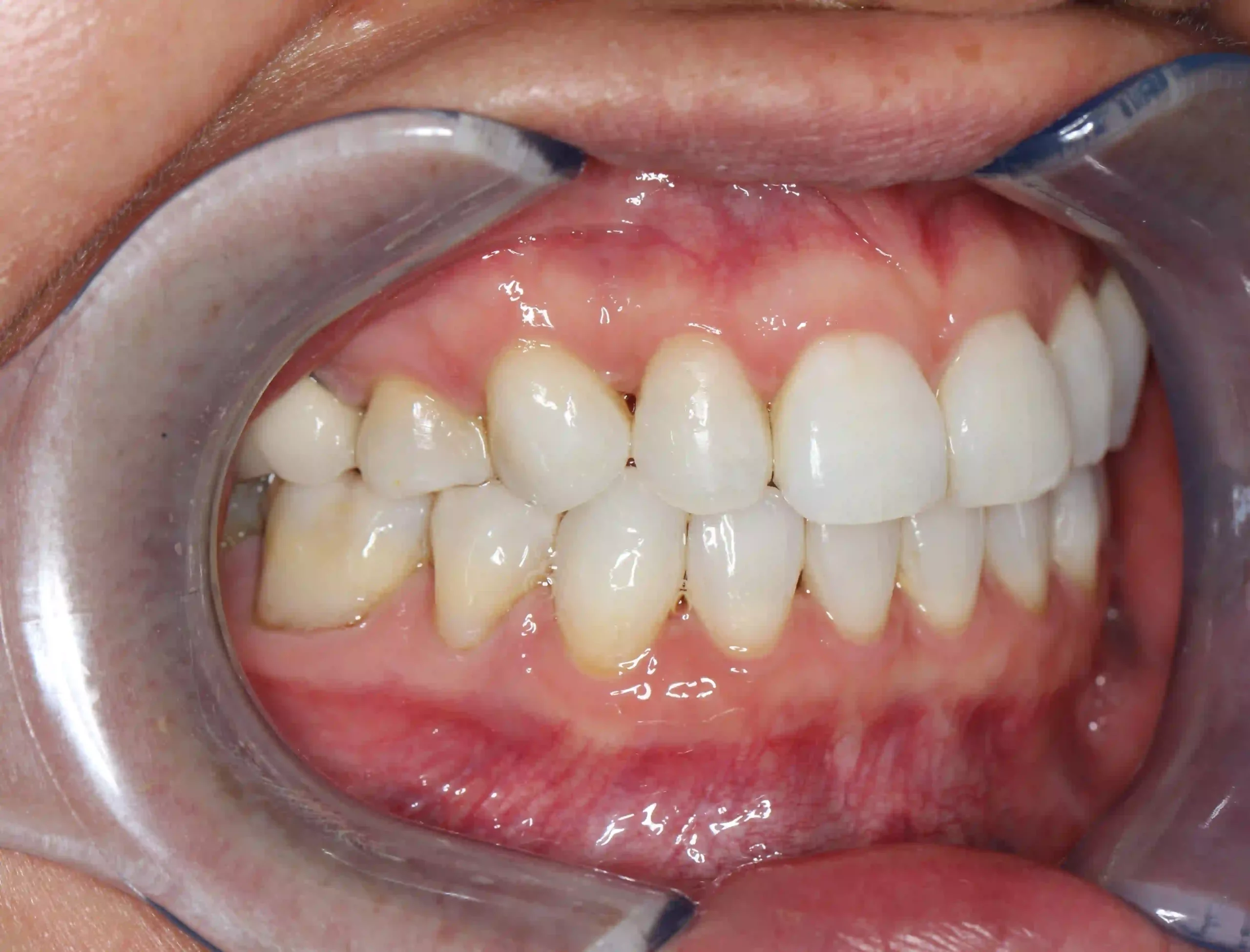 K_after-invisalign-1