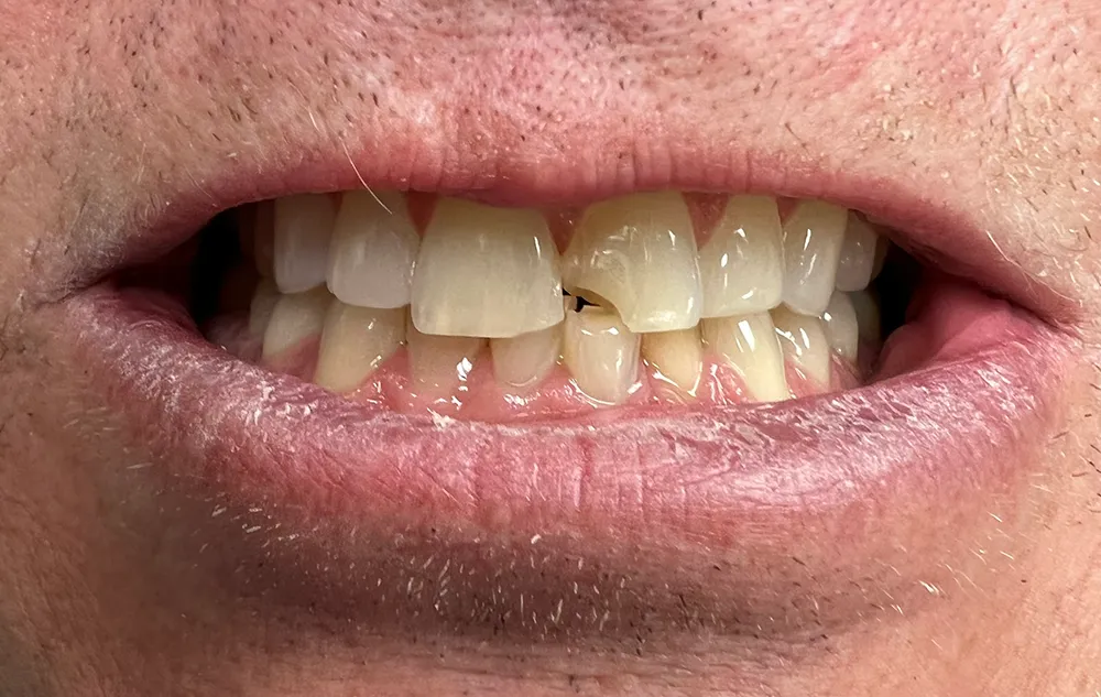 Sam_bonding-beforewebp