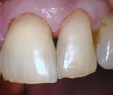 Tooth #9 and 10 after