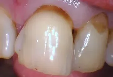 Tooth #9 and 10 before