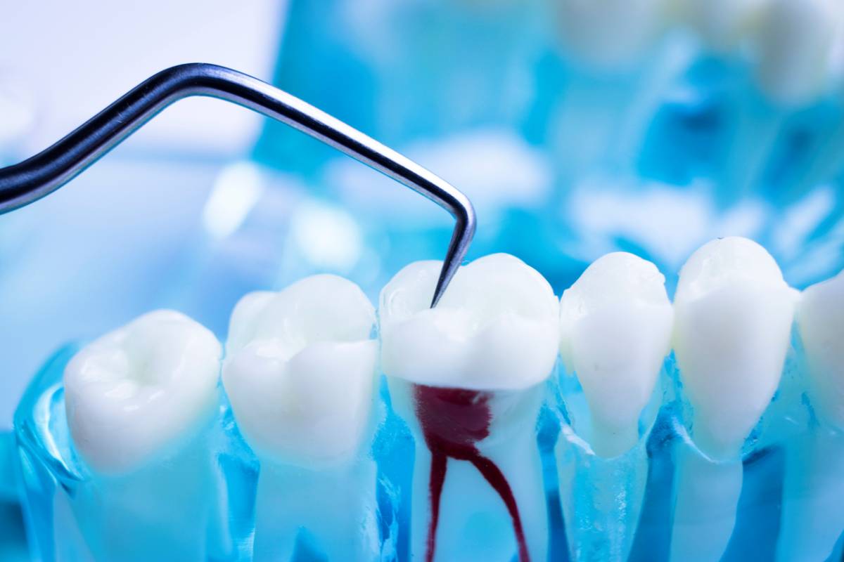 Can a Root Canal Change Tooth Color?