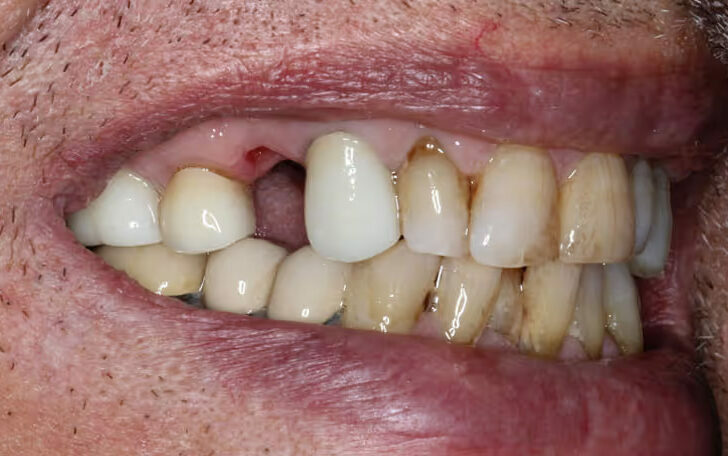 dental implants before-01