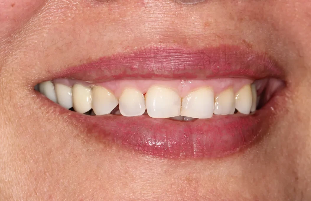 implant-03-after(1) (1).webp