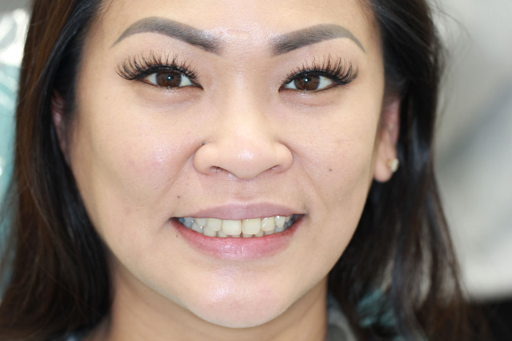 invisalign after1-2 01-2025