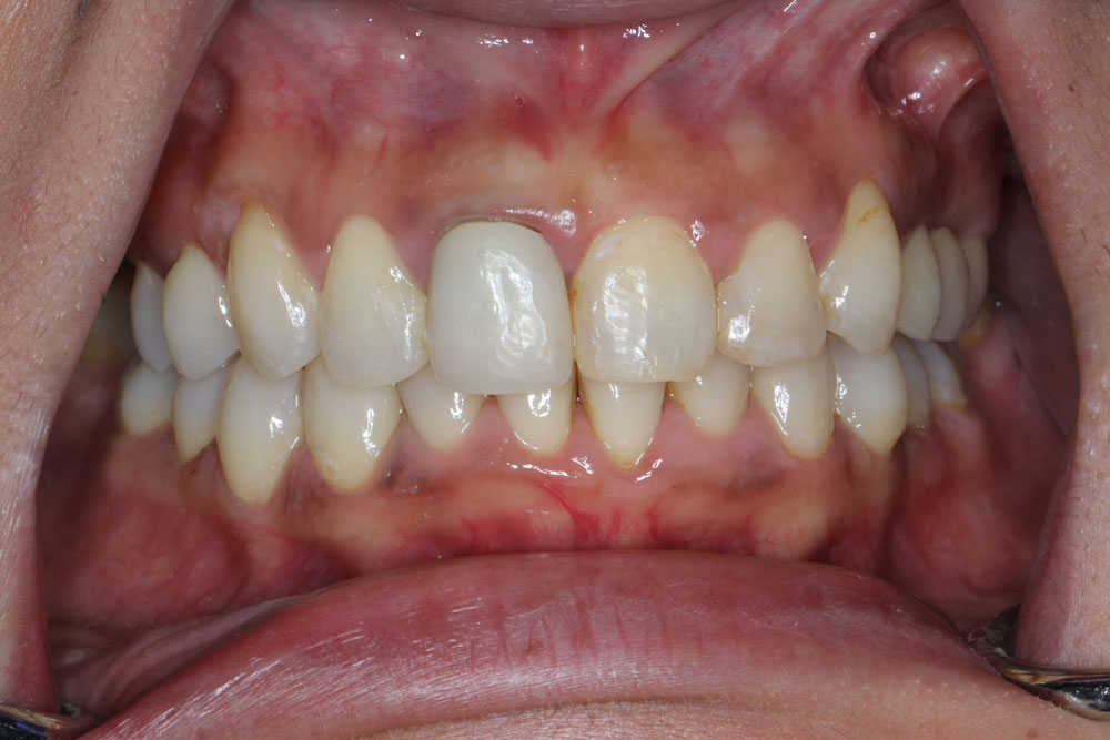 invisalign after2-2 01-2025