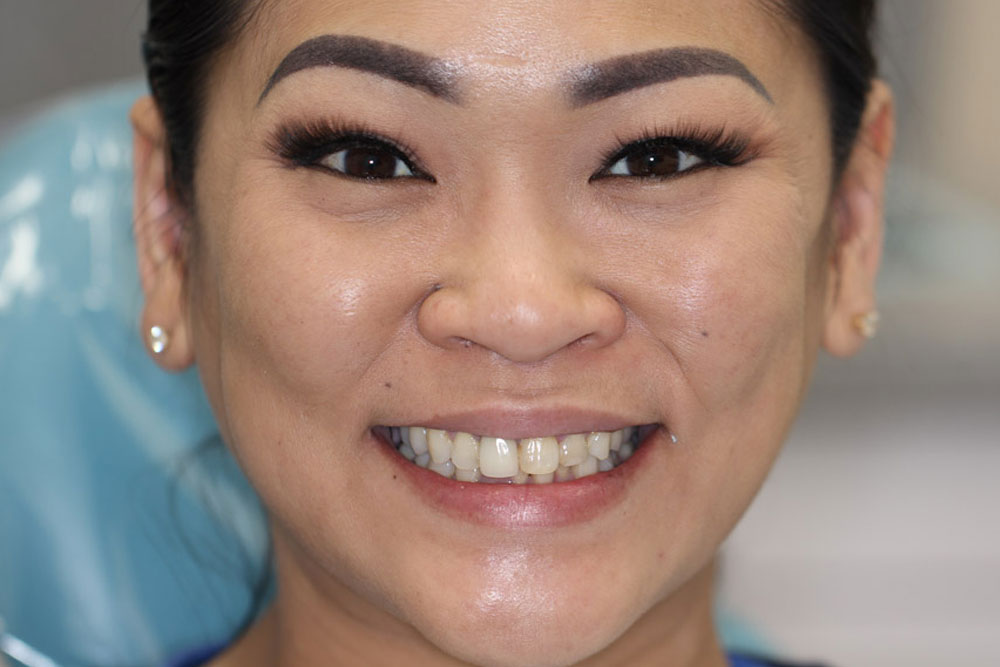 invisalign-before1-1a-01-2025