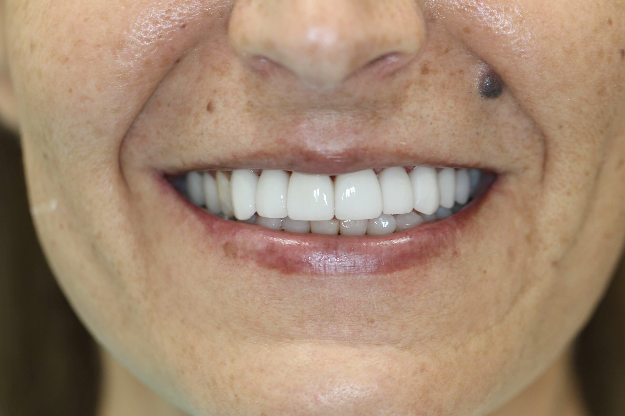 veneers after image 09062025