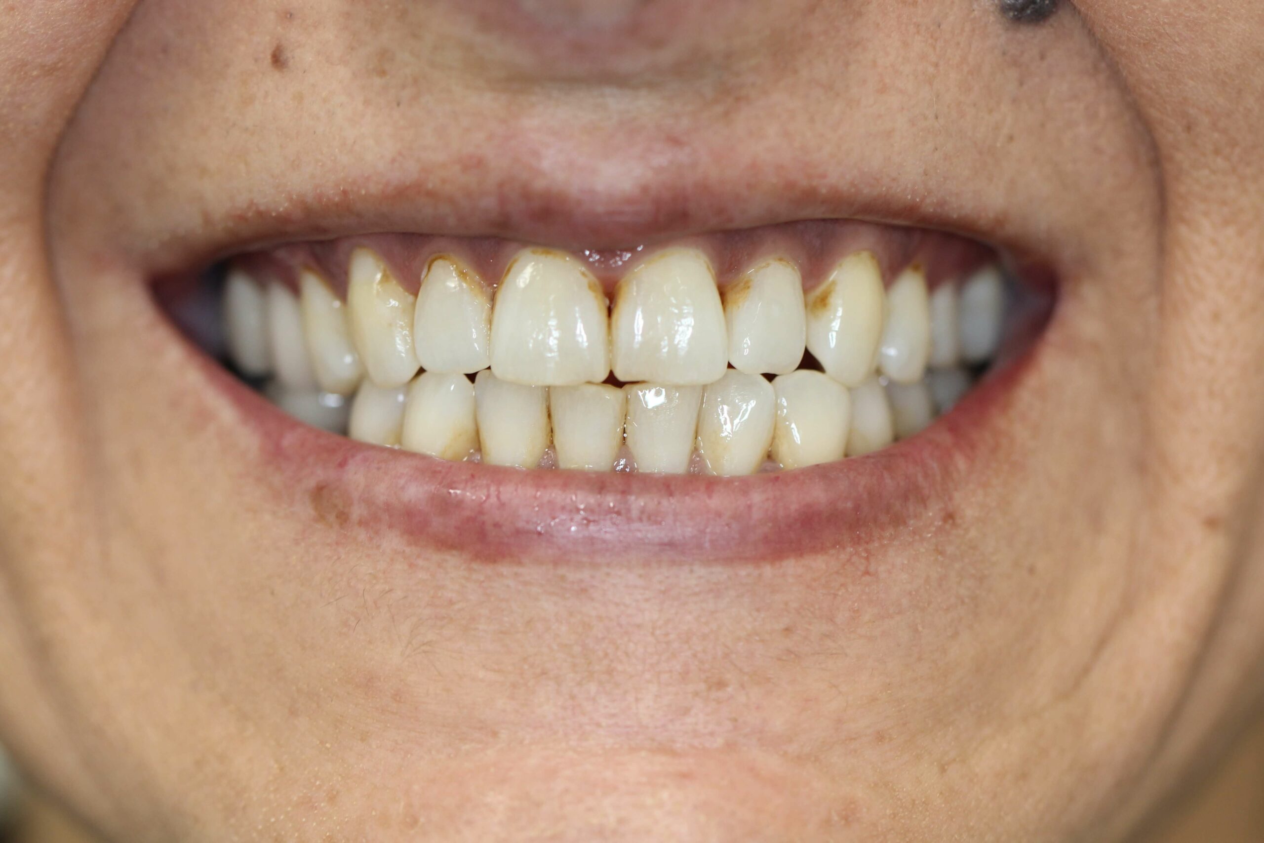 veneers before image 09062025