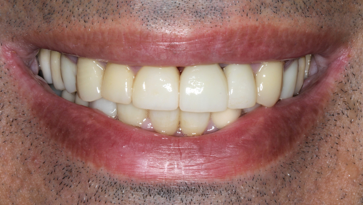 implant-after-04